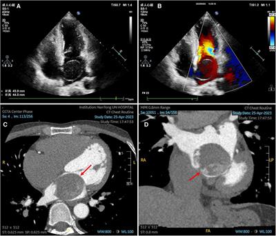Case Report: Giant left atrial cystic tumor: myxoma or intracardiac blood cyst?